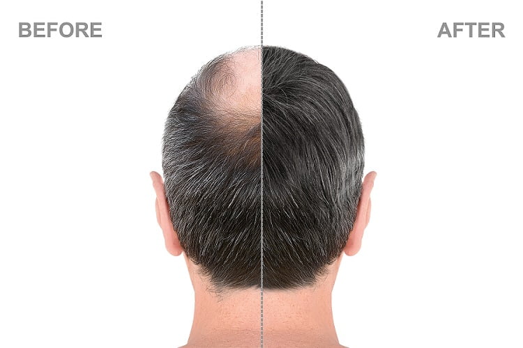 IMG20170712WA0004  Best Hair Transplant in IndiaChandigarh Reviva  Clinic