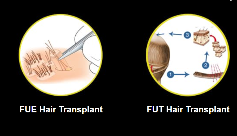 Best Hair Transplant Clinics in Punjab - YD News - You can Trust
