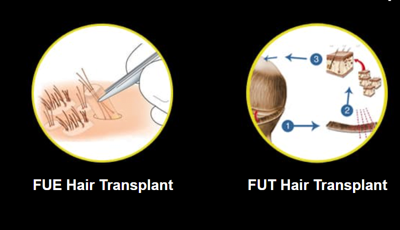 Hair Transplant Before  After Gallery  Cosmetic Surgery in Ludhiana  Plastic Surgery in Punjab Laser and Cosmetic Surgeon in Ludhiana Punjab  India