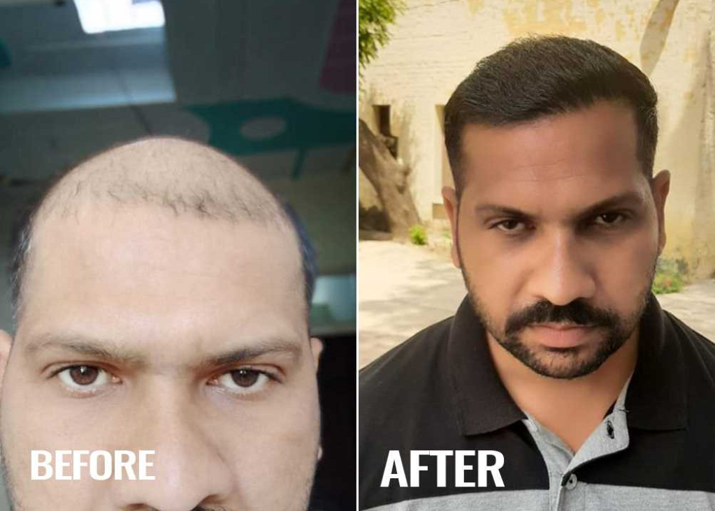 Hair Transplant in Jalandhar by Top Hair Transplant Surgeon  AK Clinic